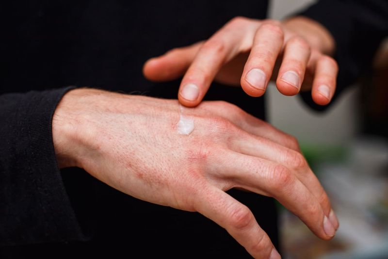 Hand wird mit Propoliscreme von Bienenherz behandelt