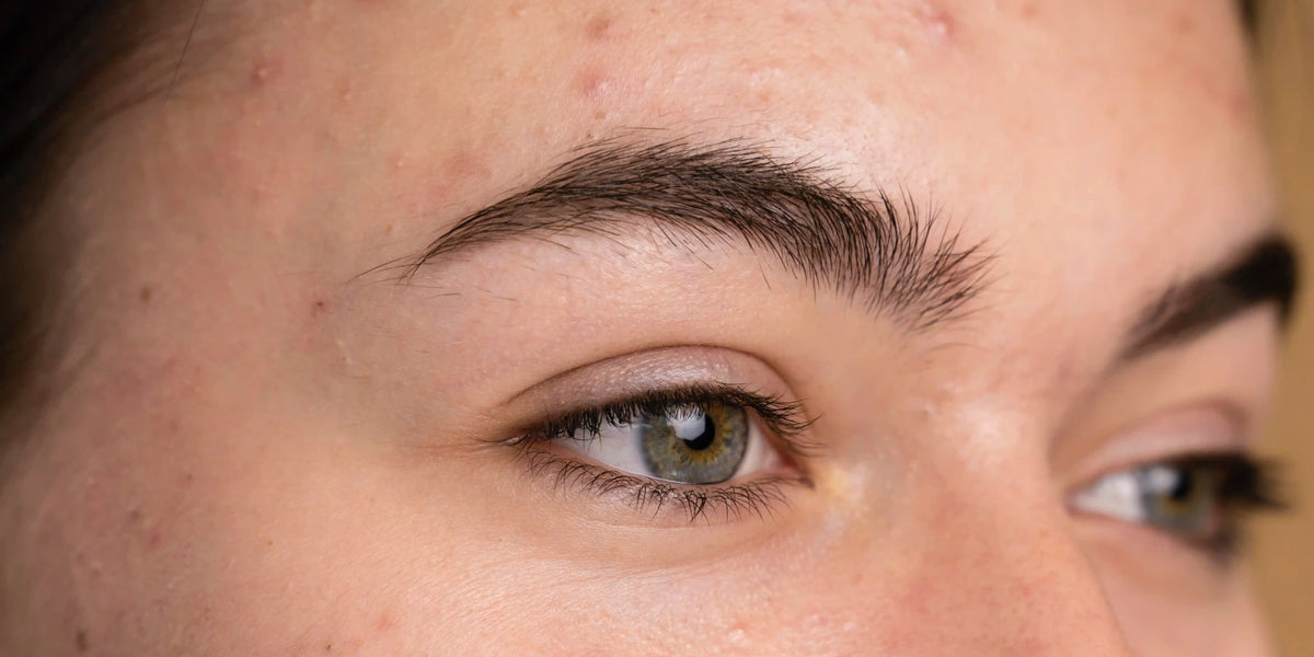 Junge Frau mit unreiner, zu Akne neigender Haut bei der äußerlichen Anwendung von Propolis.